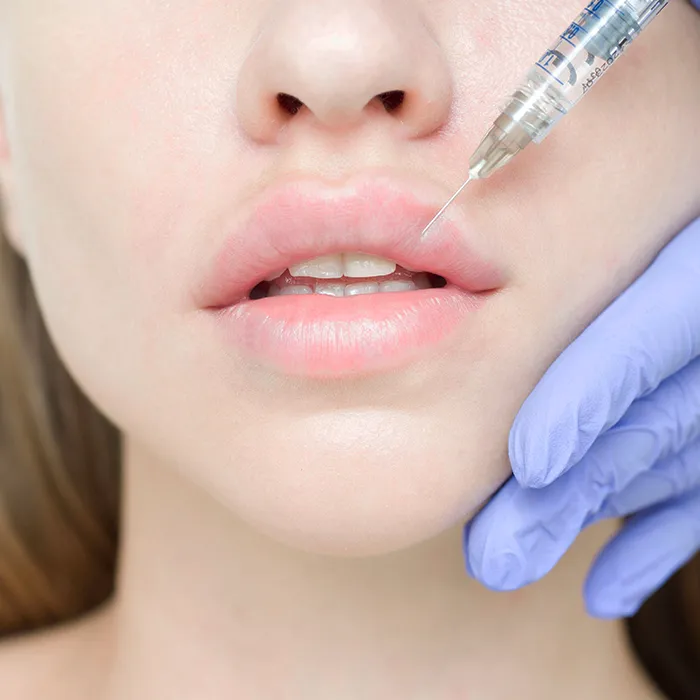 Modelowanie ust kwasem hialuronowym Nowy Sącz